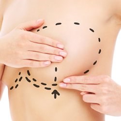 Nipple Reduction in Beverly Hills, CA