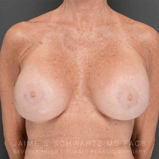 Breast Revision Before and After Pictures Beverly Hills, CA