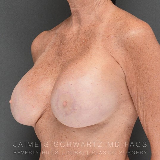 Breast Revision Before and After Pictures Beverly Hills, CA