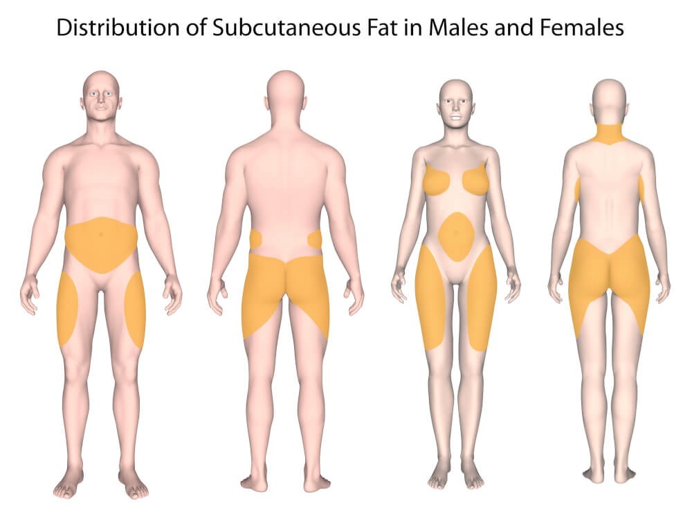 Lipedema  Fat Disorder - Causes, Stages, Symptoms, Diagnosis