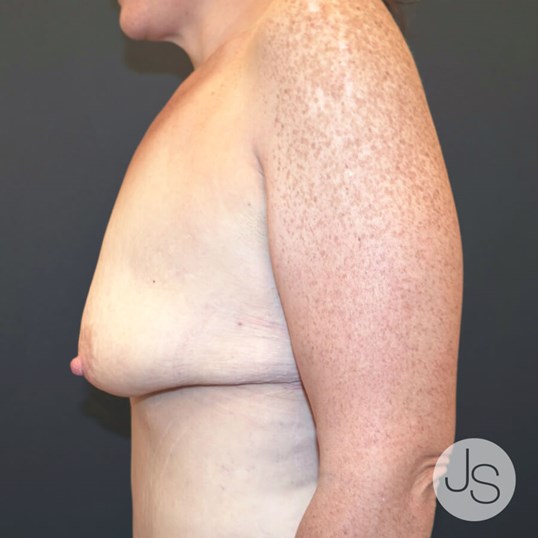 After Weight Loss Surgery Before and After Pictures Beverly Hills, CA