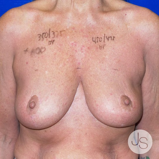 Breast Revision Before and After Pictures Beverly Hills, CA