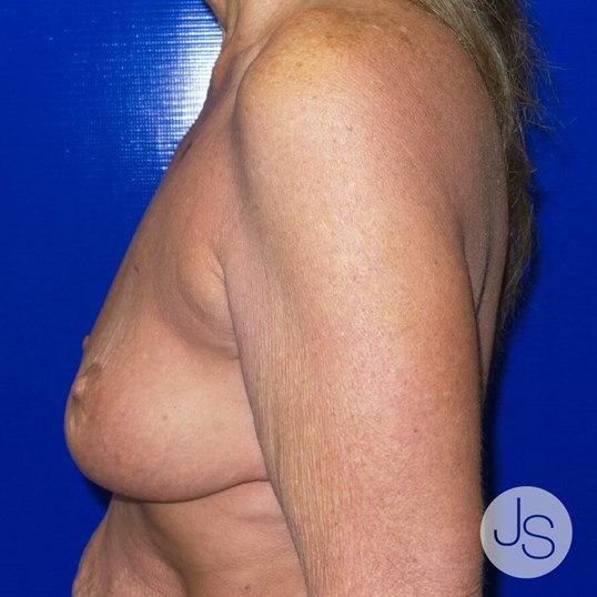 Breast Revision Before and After Pictures Beverly Hills, CA