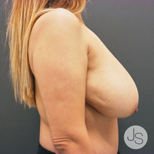 Breast Reduction Before and After Pictures Beverly Hills, CA