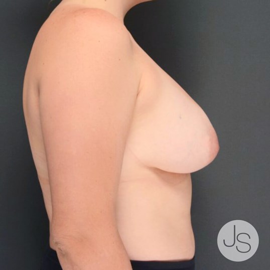 Breast Lift Before and After Pictures Beverly Hills, CA