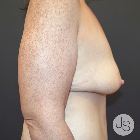 Breast Lift Before and After Pictures Beverly Hills, CA
