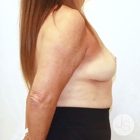 Breast Lift Before and After Pictures Beverly Hills, CA