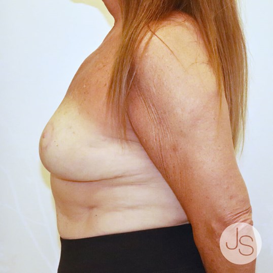 Breast Lift Before and After Pictures Beverly Hills, CA