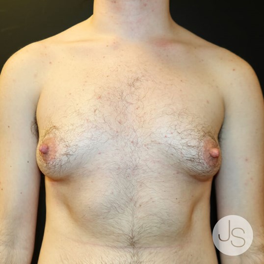 Breast Reduction Before and After Pictures Beverly Hills, CA