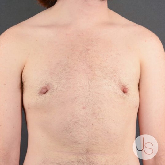 Breast Reduction Before and After Pictures Beverly Hills, CA