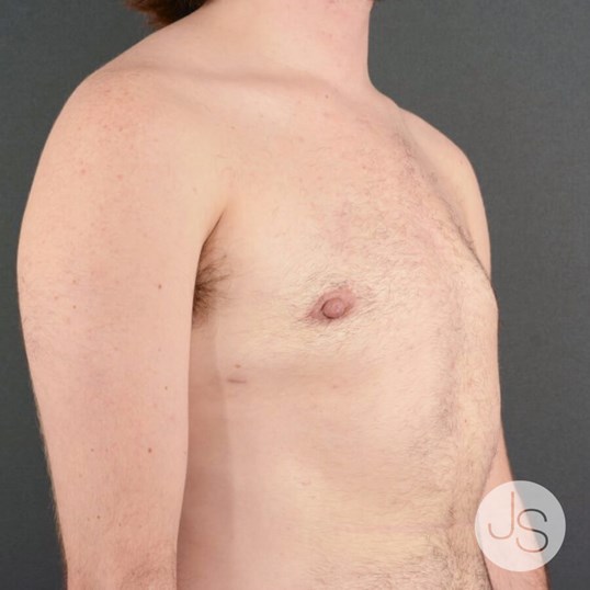 Breast Reduction Before and After Pictures Beverly Hills, CA