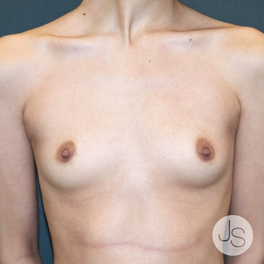 Breast Augmentation Before and After Pictures Beverly Hills, CA