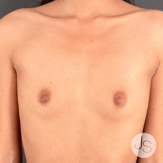 Breast Augmentation Before and After Pictures Beverly Hills, CA