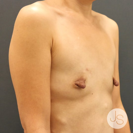 Breast Augmentation Before and After Pictures Beverly Hills, CA