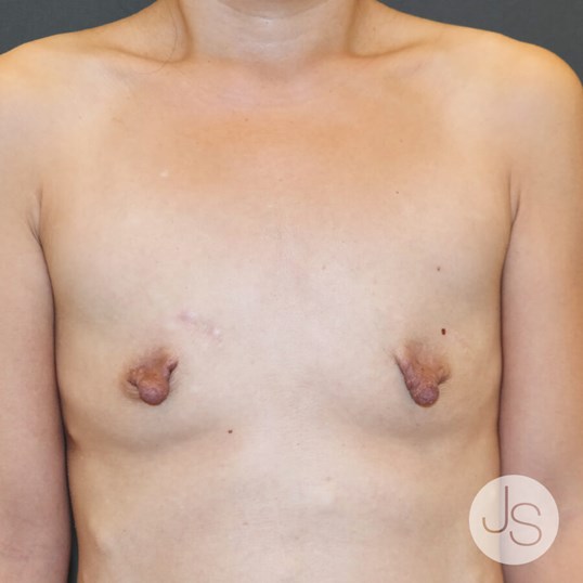 Breast Augmentation Before and After Pictures Beverly Hills, CA