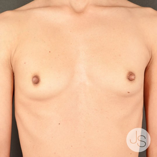 Breast Augmentation Before and After Pictures Beverly Hills, CA