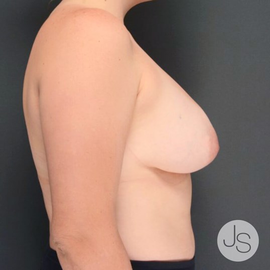 Breast Implant Removal Before and After Pictures Beverly Hills, CA