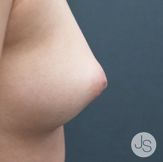 Inverted Nipple Correction Before and After Pictures Beverly Hills, CA