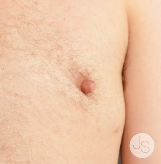 Areola Reduction Before and After Pictures Beverly Hills, CA