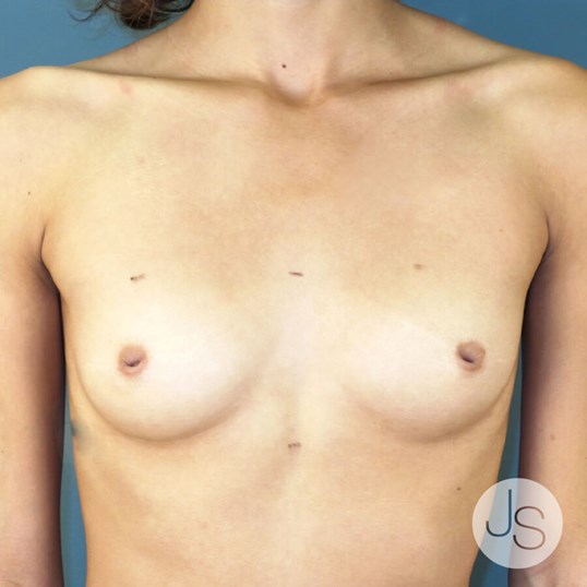 Breast Reconstruction Before and After Pictures Beverly Hills, CA