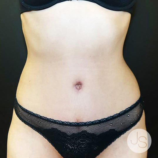 Liposuction (Smooth Lipo) Before and After Pictures Beverly Hills, CA