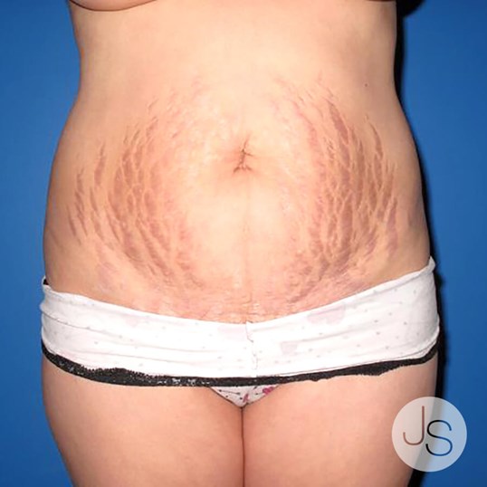 Tummy Tuck Before and After Pictures Beverly Hills, CA