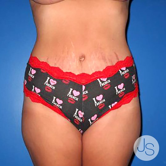 Tummy Tuck Before and After Pictures Beverly Hills, CA