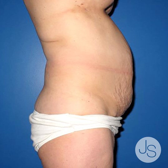 Tummy Tuck Before and After Pictures Beverly Hills, CA