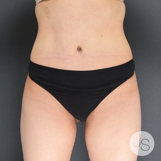 Tummy Tuck Before and After Pictures Beverly Hills, CA