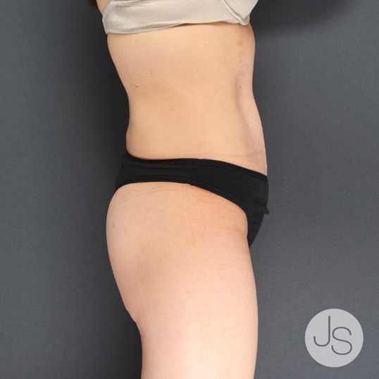 Liposuction (Smooth Lipo) Before and After Pictures Beverly Hills, CA