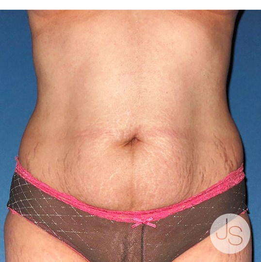 Tummy Tuck Before and After Pictures Beverly Hills, CA