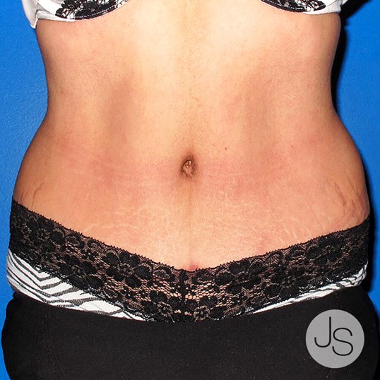 Tummy Tuck Before and After Pictures Beverly Hills, CA