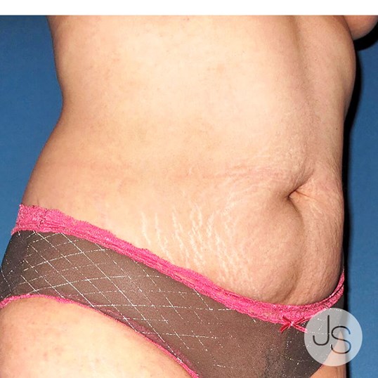 Liposuction (Smooth Lipo) Before and After Pictures Beverly Hills, CA