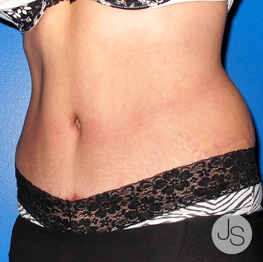 Tummy Tuck Before and After Pictures Beverly Hills, CA