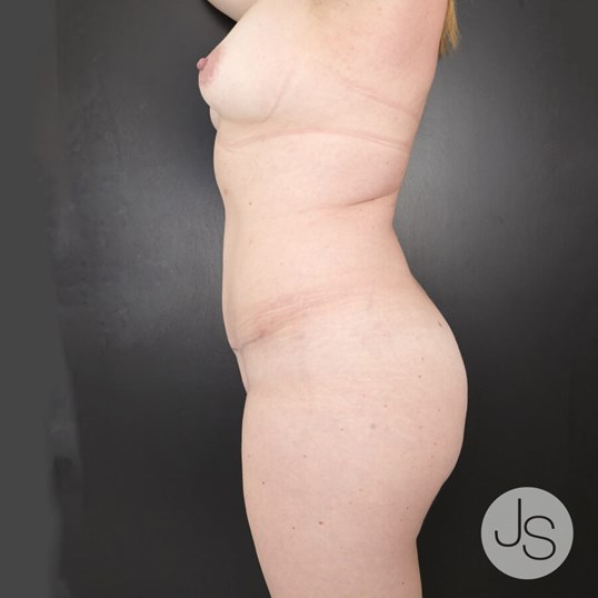 Tummy Tuck Before and After Pictures Beverly Hills, CA