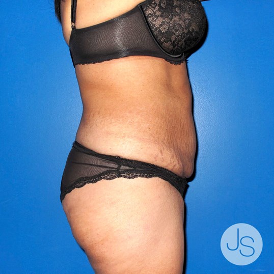 Tummy Tuck Before and After Pictures Beverly Hills, CA