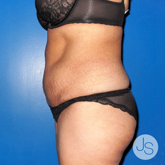 Liposuction (Smooth Lipo) Before and After Pictures Beverly Hills, CA