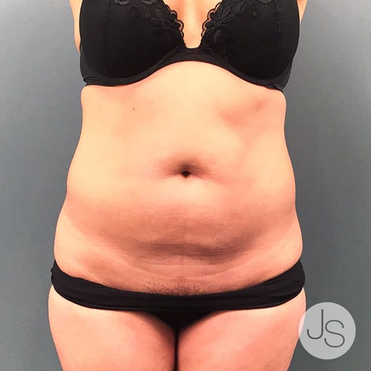 Tummy Tuck Before and After Pictures Beverly Hills, CA