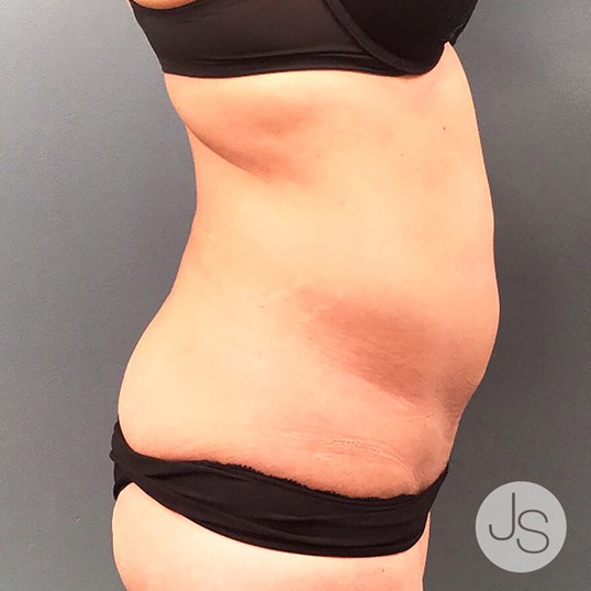 Liposuction (Smooth Lipo) Before and After Pictures Beverly Hills, CA