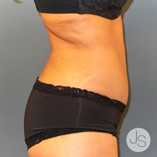 Tummy Tuck Before and After Pictures Beverly Hills, CA