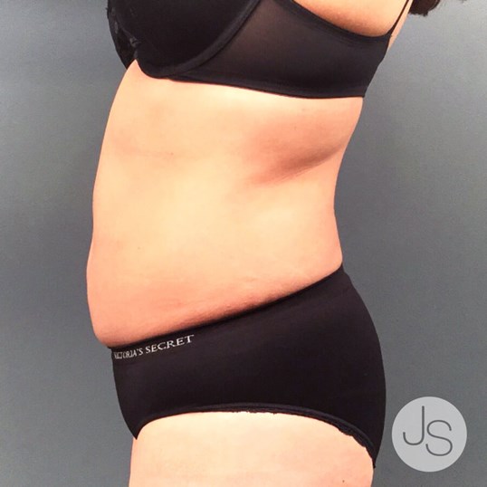 Liposuction (Smooth Lipo) Before and After Pictures Beverly Hills, CA