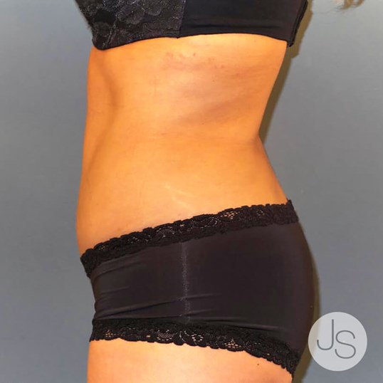 Tummy Tuck Before and After Pictures Beverly Hills, CA