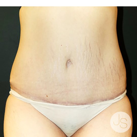 Tummy Tuck Before and After Pictures Beverly Hills, CA