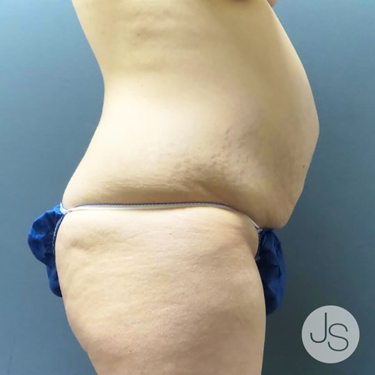 Tummy Tuck Before and After Pictures Beverly Hills, CA