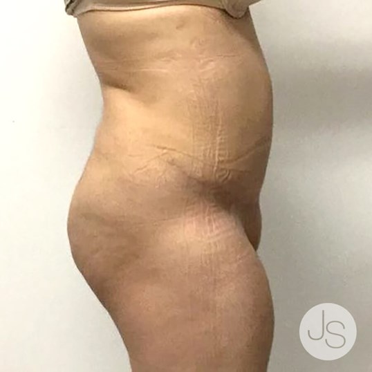 Tummy Tuck Before and After Pictures Beverly Hills, CA