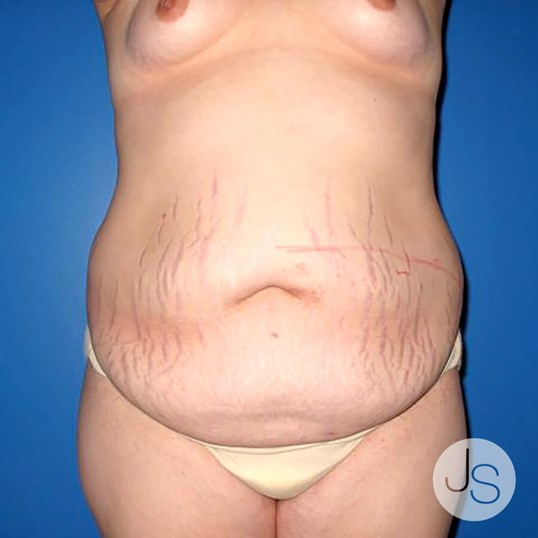 Tummy Tuck Before and After Pictures Beverly Hills, CA