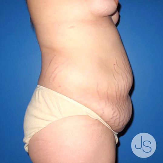 Tummy Tuck Before and After Pictures Beverly Hills, CA