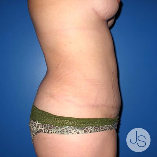 After Weight Loss Surgery Before and After Pictures Beverly Hills, CA