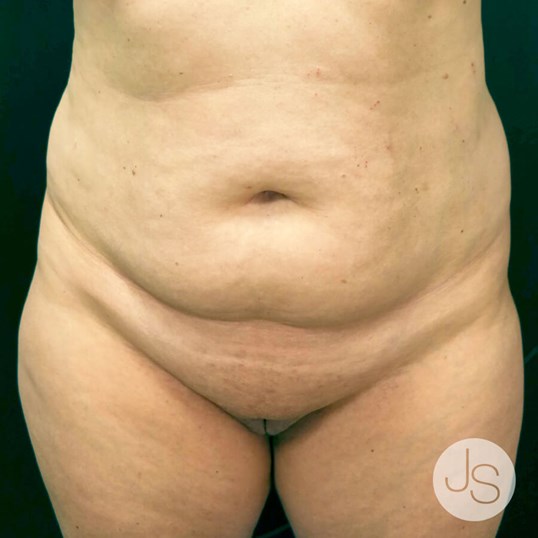 After Weight Loss Surgery Before and After Pictures Beverly Hills, CA