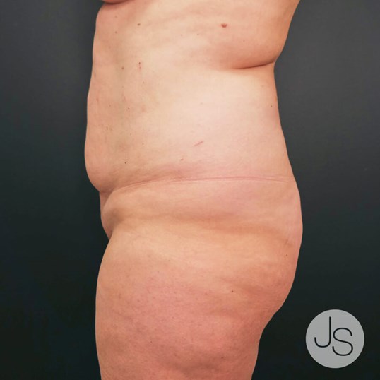 After Weight Loss Surgery Before and After Pictures Beverly Hills, CA